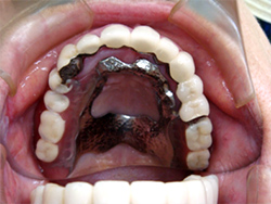 アタッチメント義歯を装着した状態（口腔内）｜はめていると気づかれない義歯